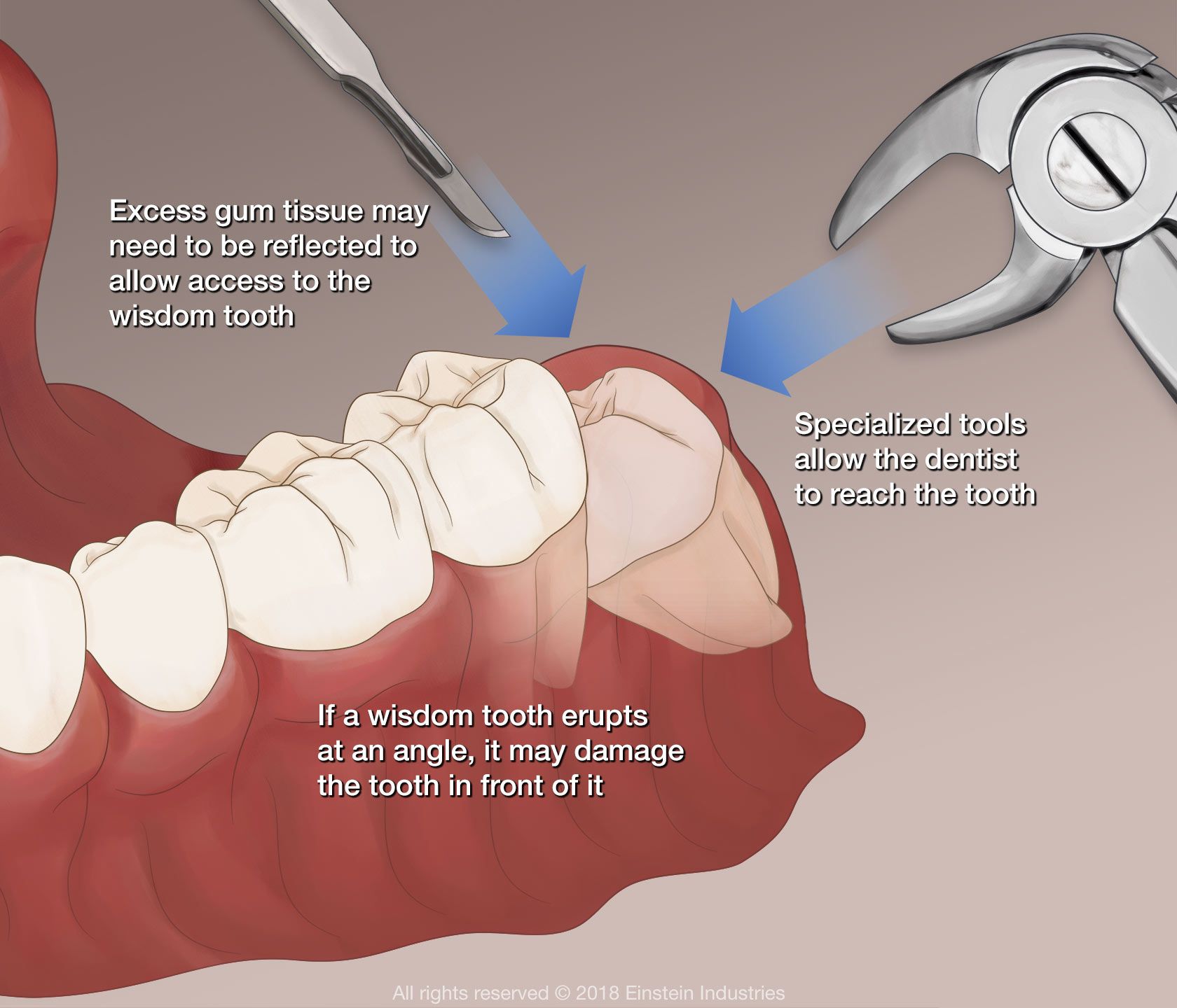 procedure of how wisdom teeth removal is performed